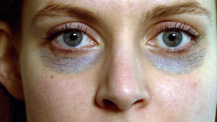 علاج الهالات السوداء تحت العين